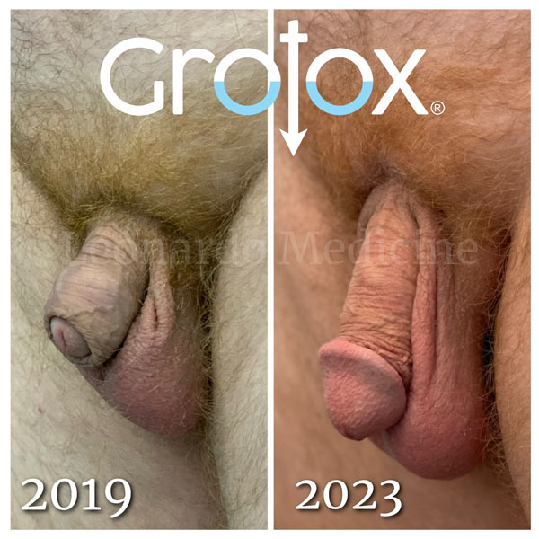 GroTox® treatment 25