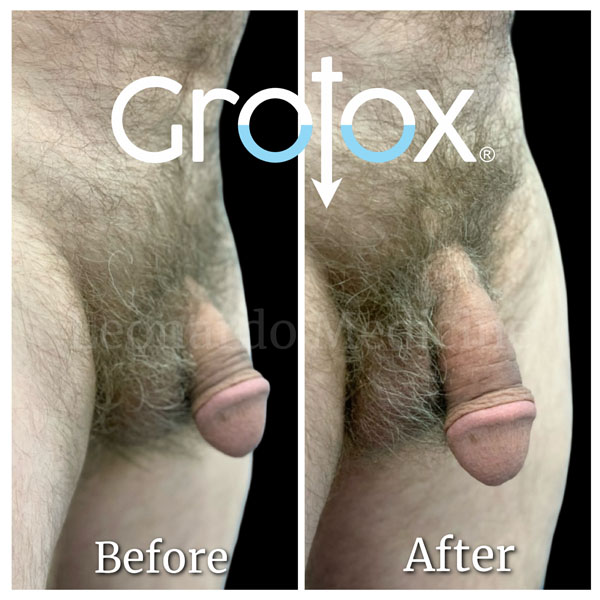 GroTox® treatment 26