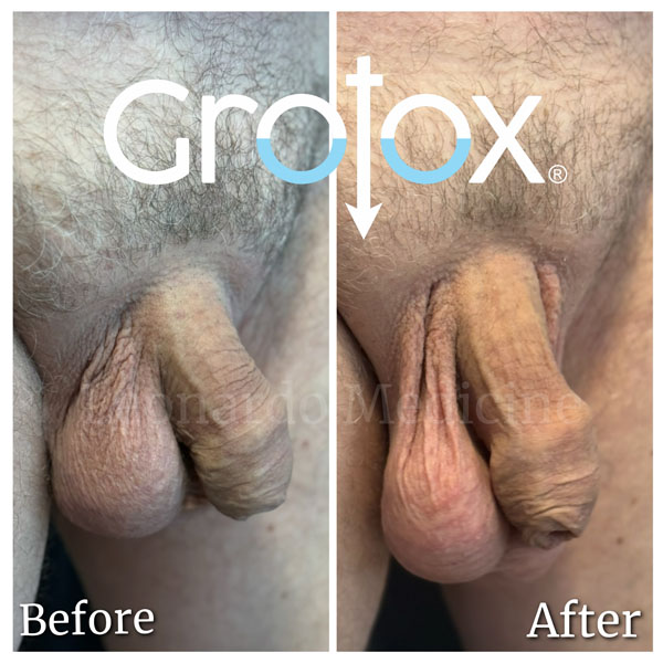 GroTox® treatment 27
