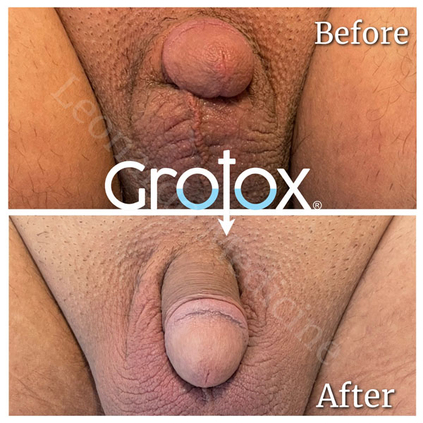 GroTox® treatment 28