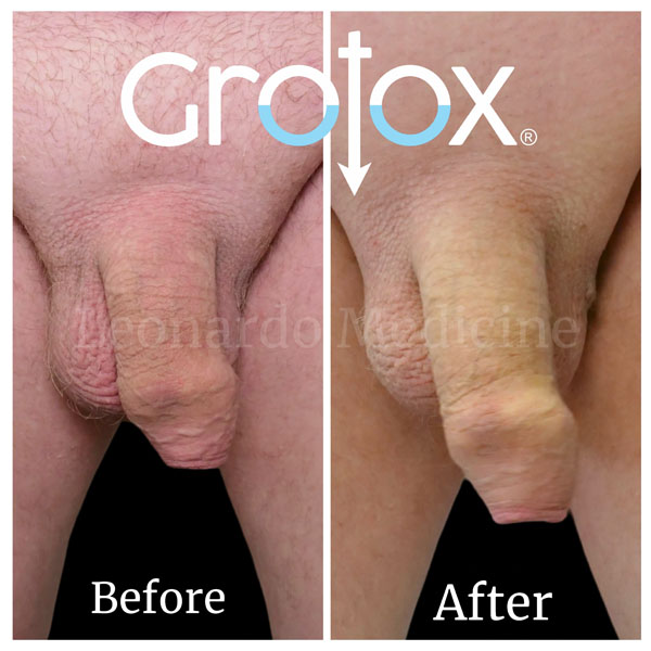 GroTox® treatment 29