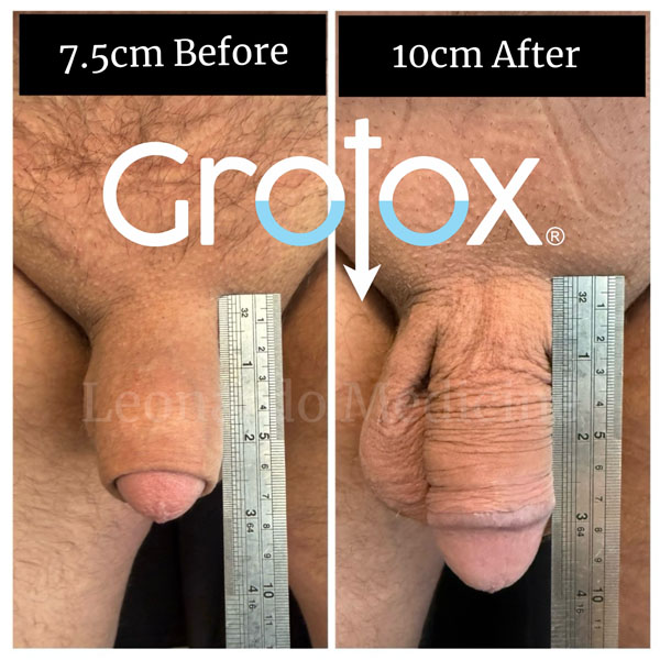 GroTox® treatment 3
