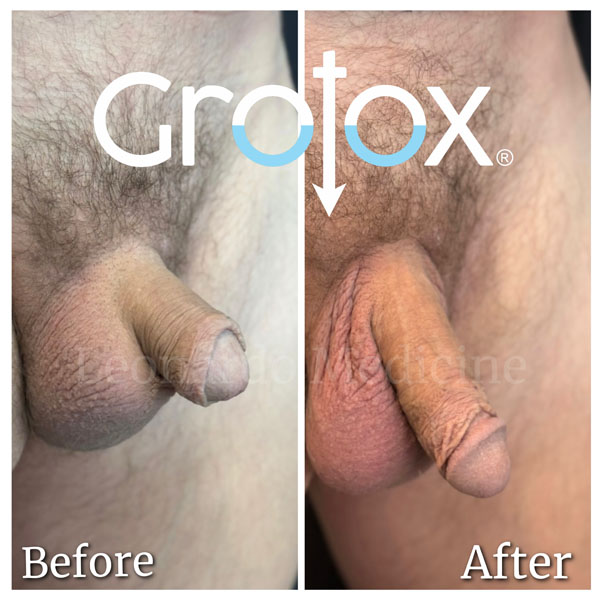 GroTox® treatment 30