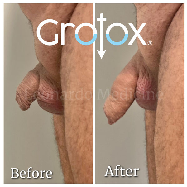 GroTox® treatment 31