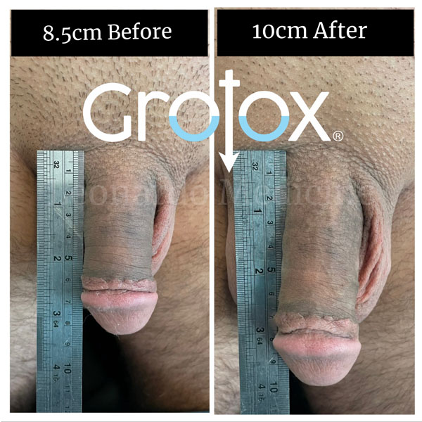 GroTox® treatment 4