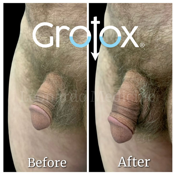 GroTox® treatment 5