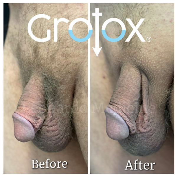 GroTox® treatment 7