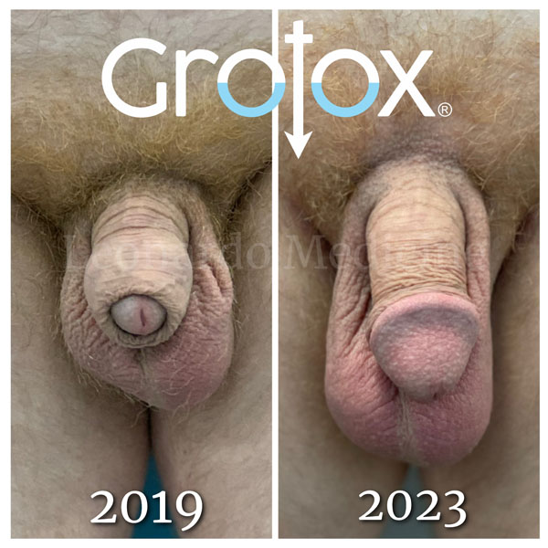 GroTox® treatment 8