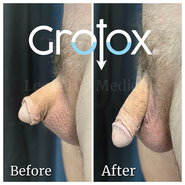 GroTox® treatment 9