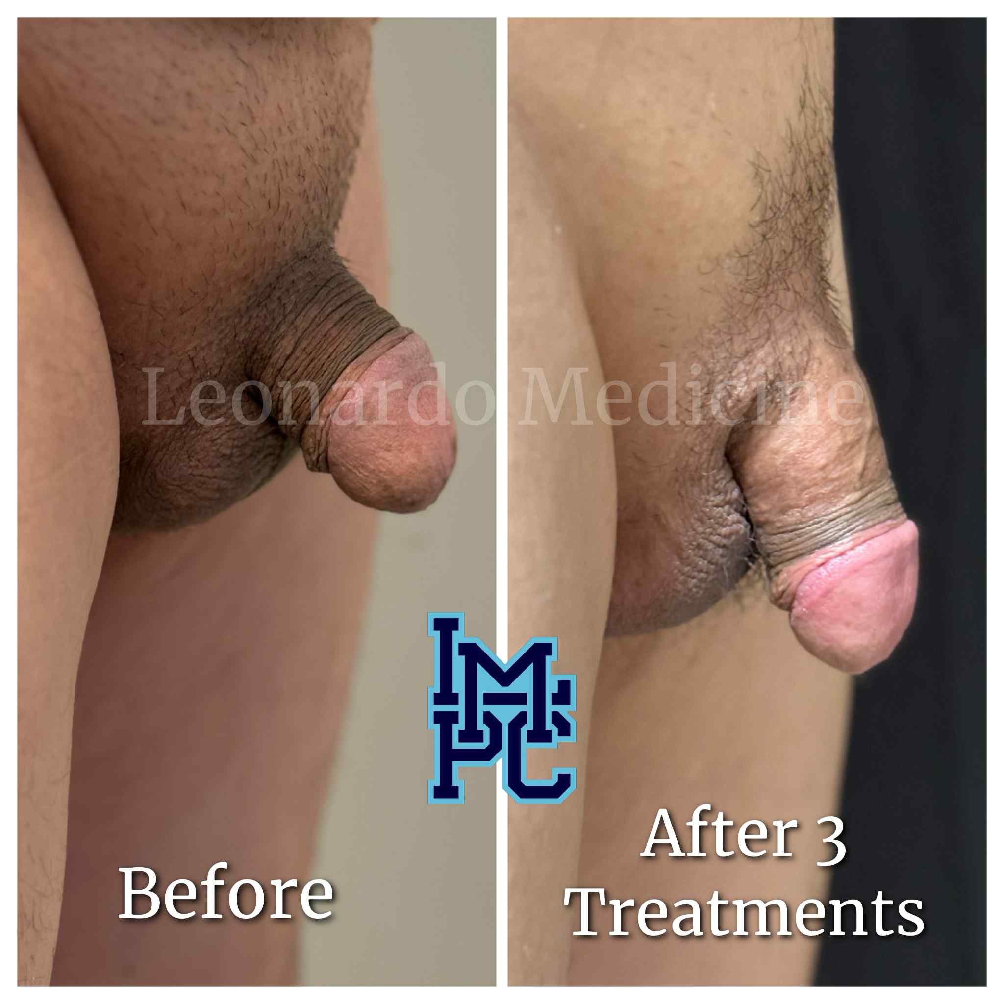 Lipodissolve Treatment 10