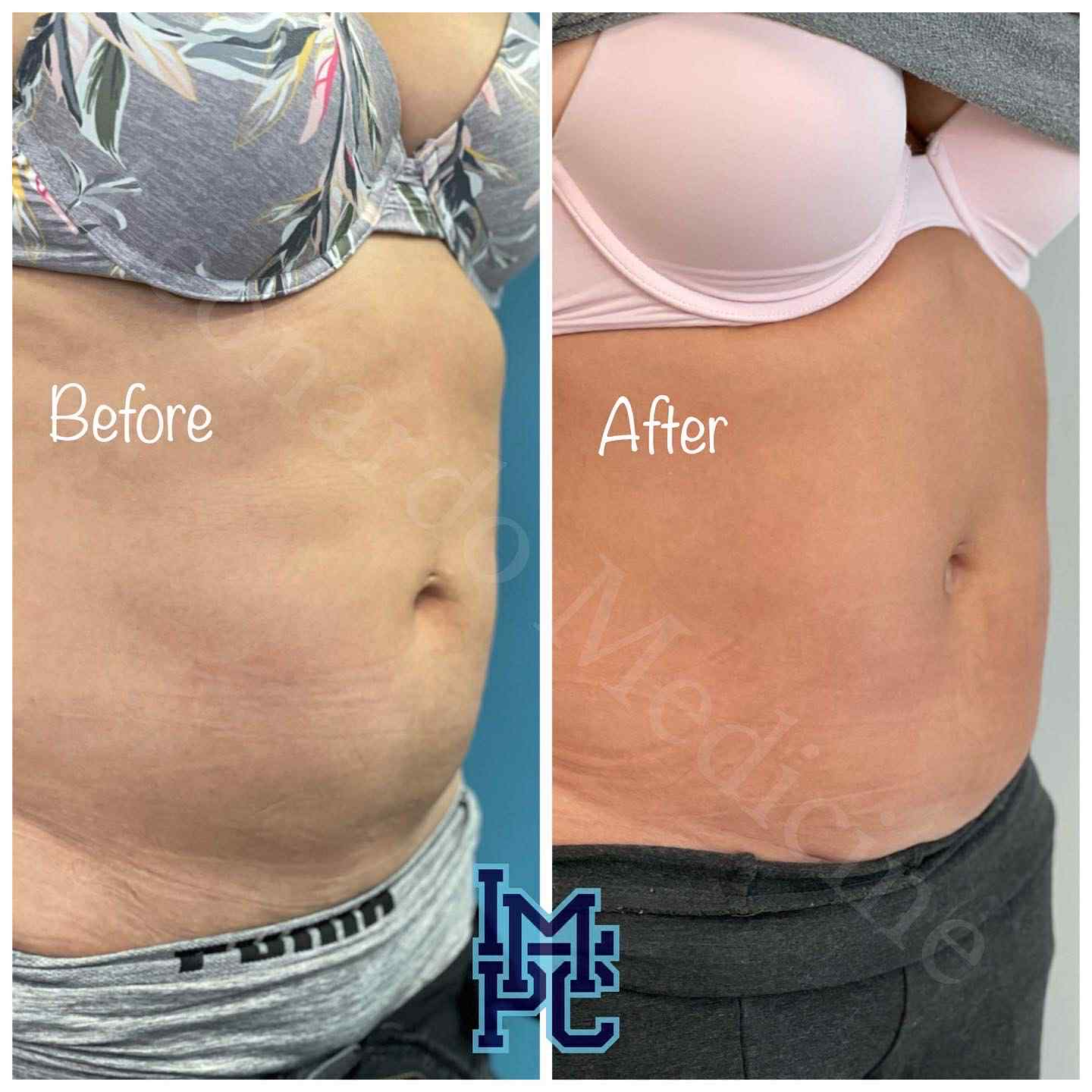 Lipodissolve Treatment 12