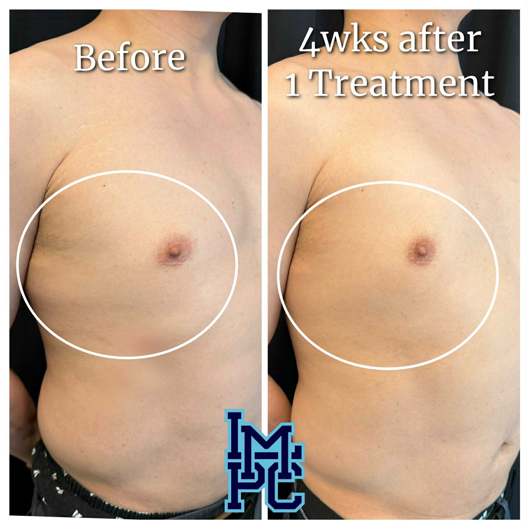 Lipodissolve Treatment 13