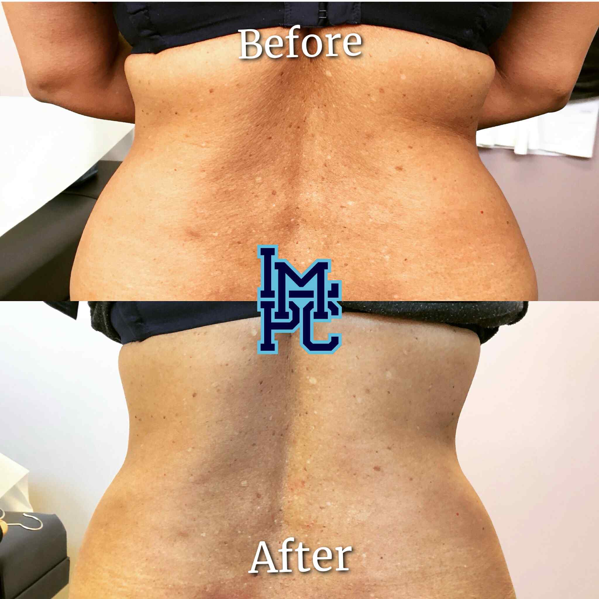 Lipodissolve Treatment 14