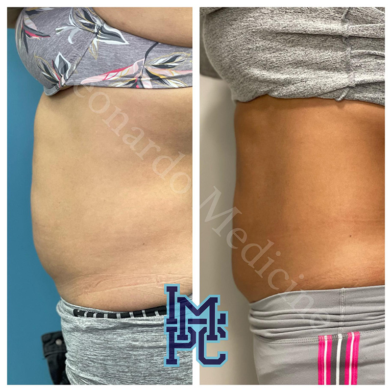 Lipodissolve Treatment 16
