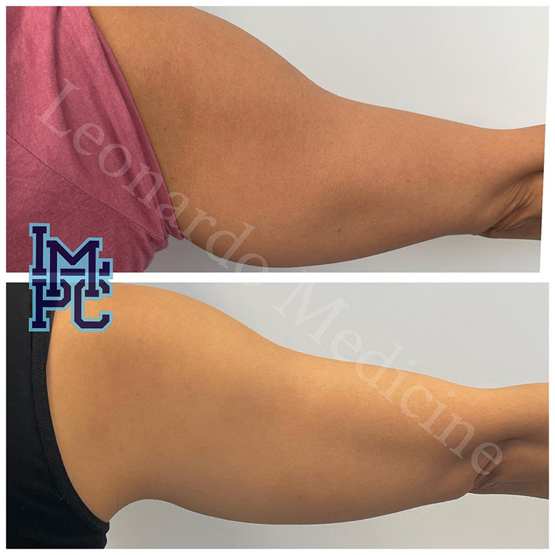 Lipodissolve Treatment 17