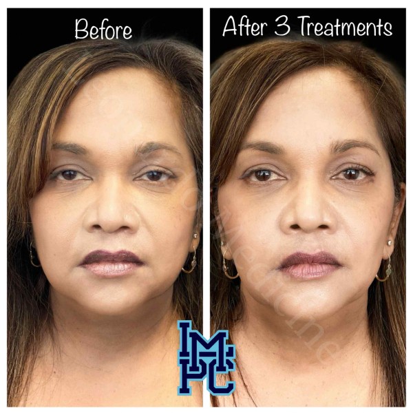 Lipodissolve treatment 18