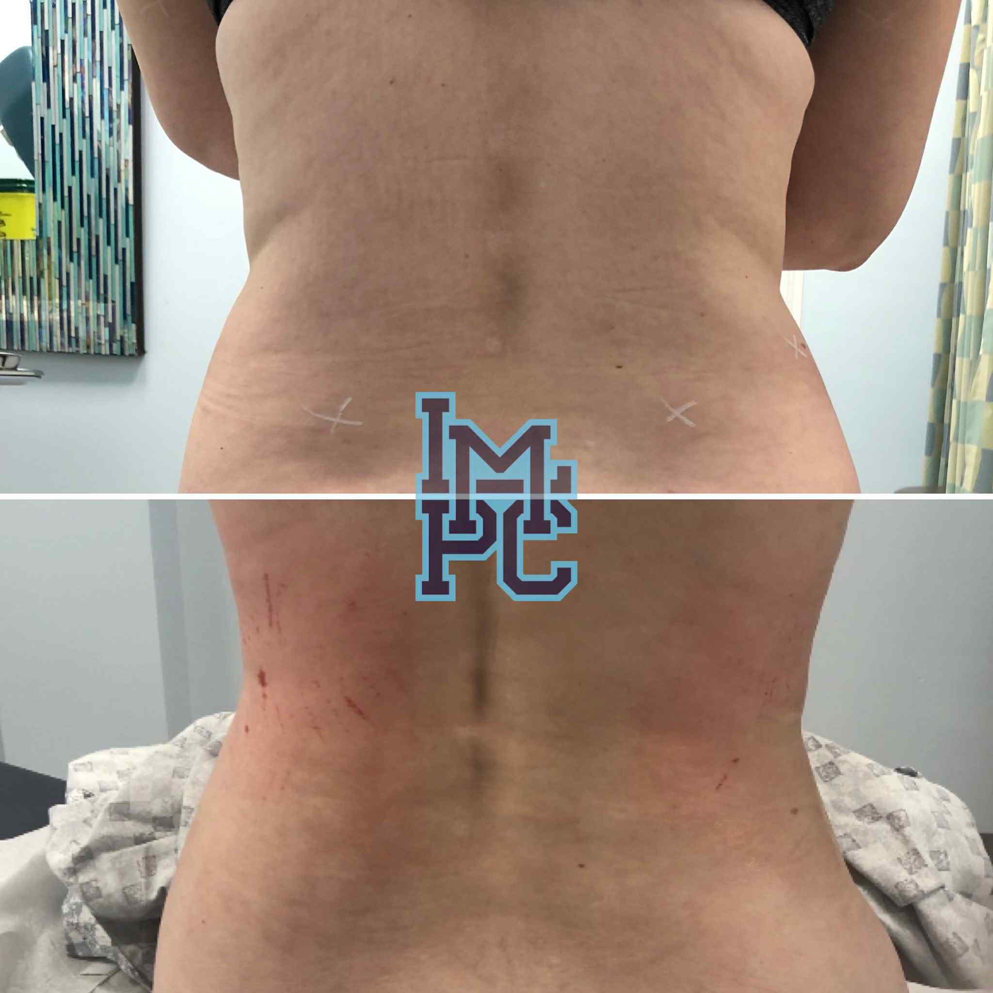 Lipodissolve Treatment 2
