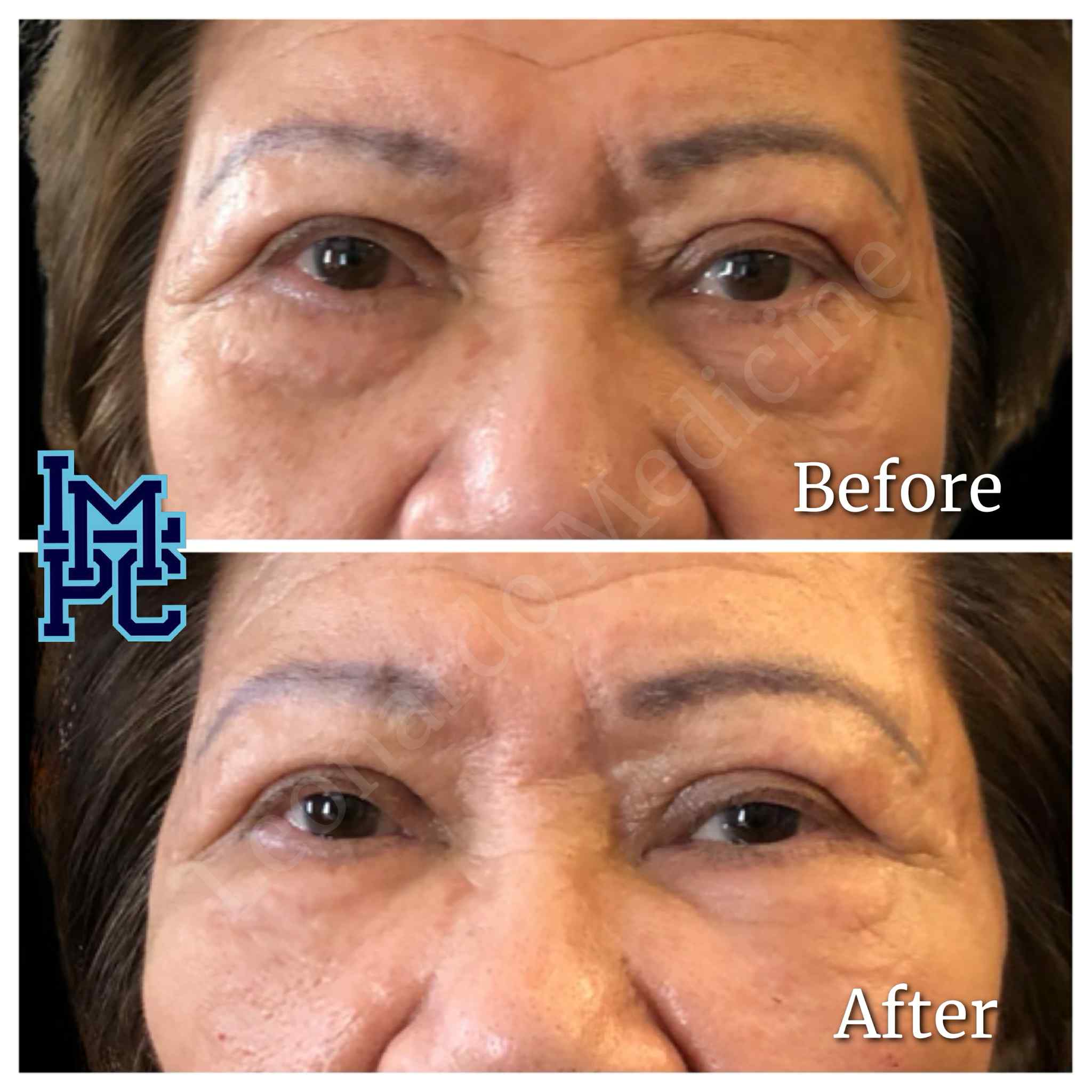 Lipodissolve Treatment 4