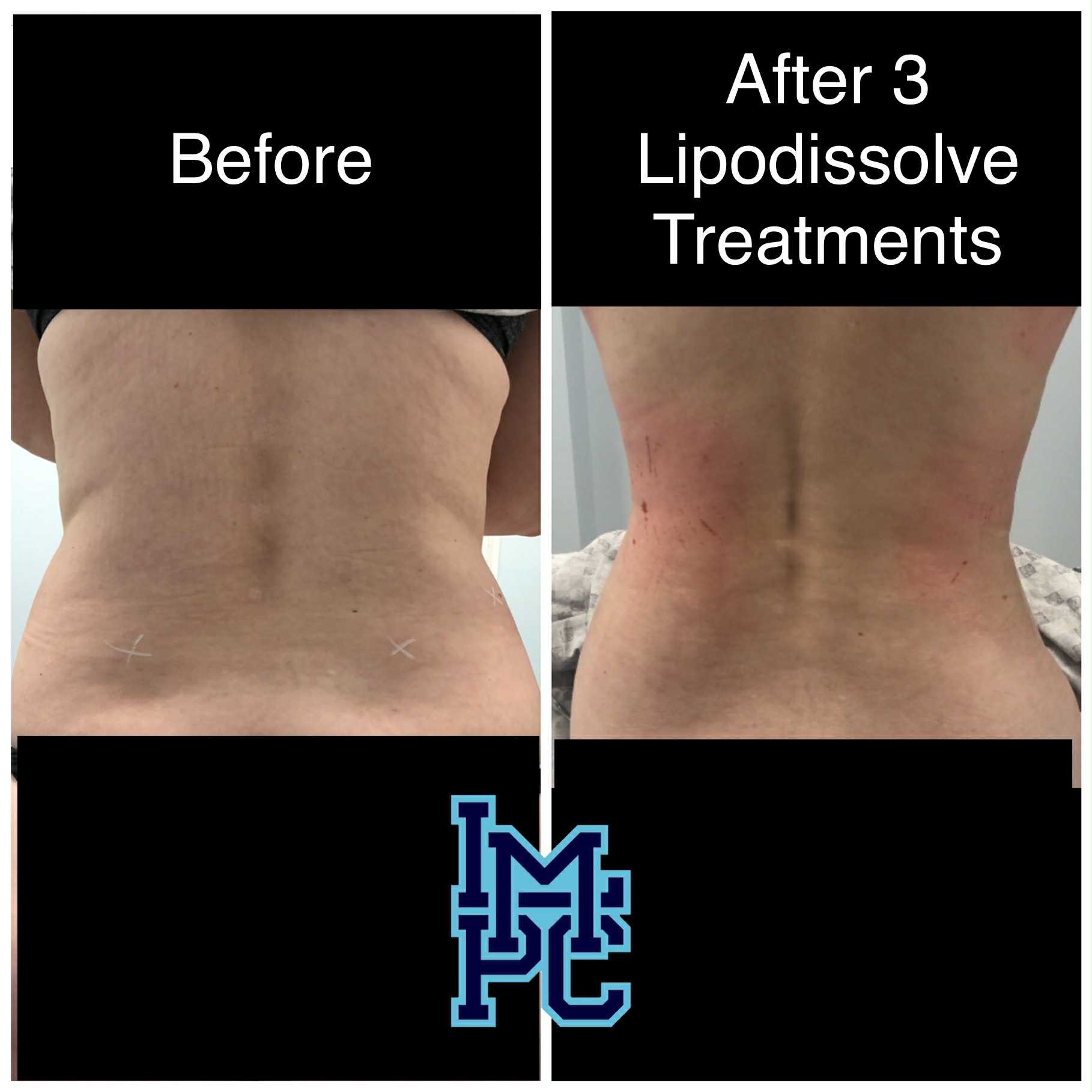 Lipodissolve Treatment 5