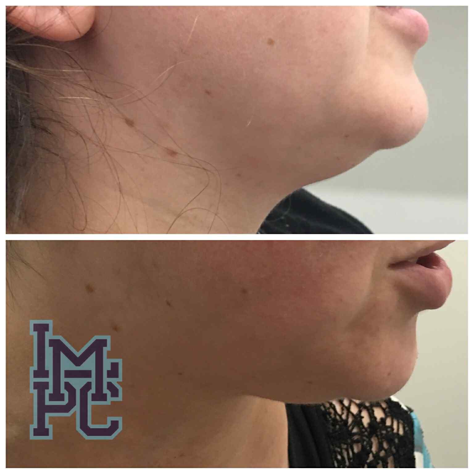 Lipodissolve Treatment 6