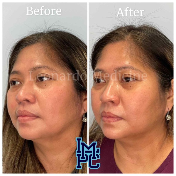 Lower Face Filler treatment 1