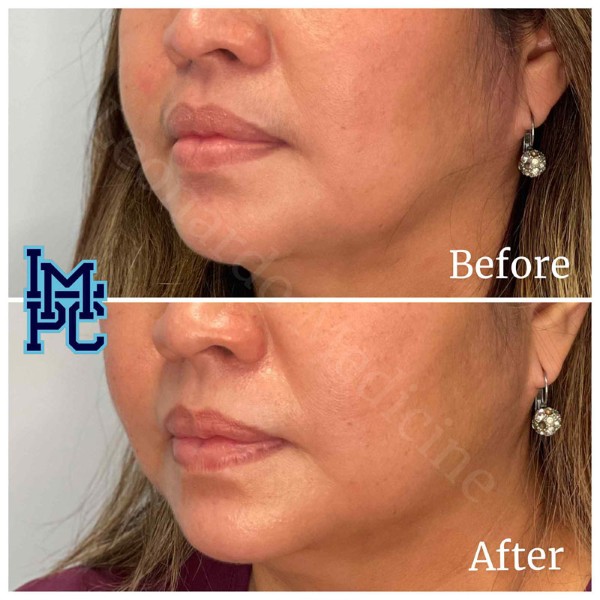 Lower Face Filler treatment 10