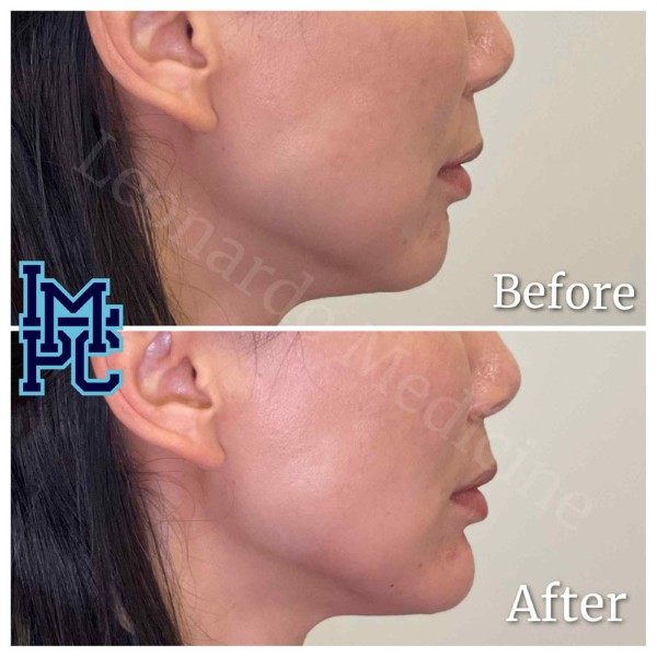 Lower Face Filler treatment 14