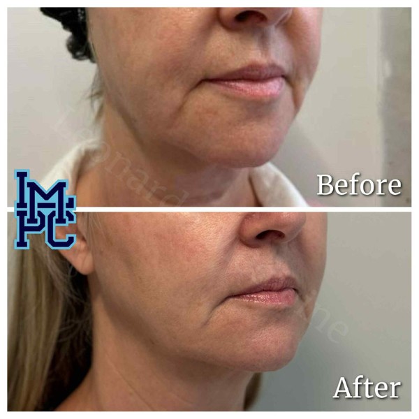 Lower Face Filler treatment 23