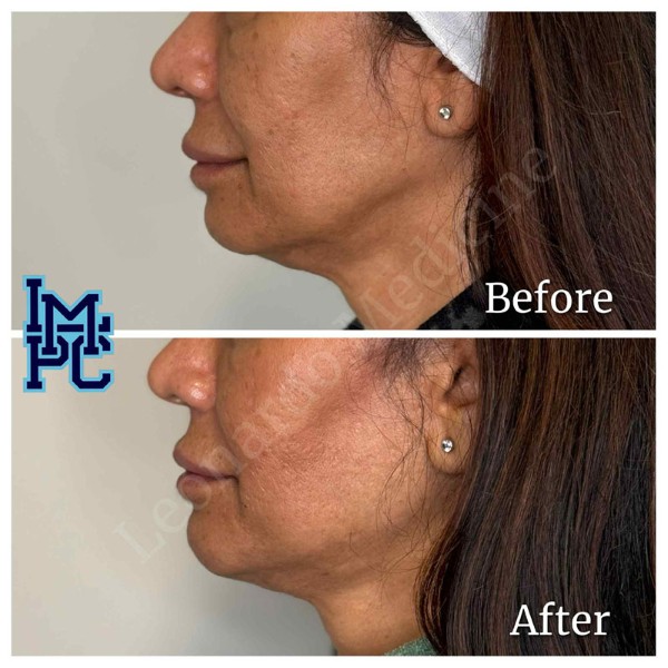 Lower Face Filler treatment 36
