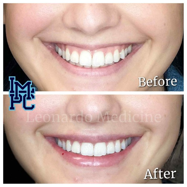 Lower Face Filler treatment 43