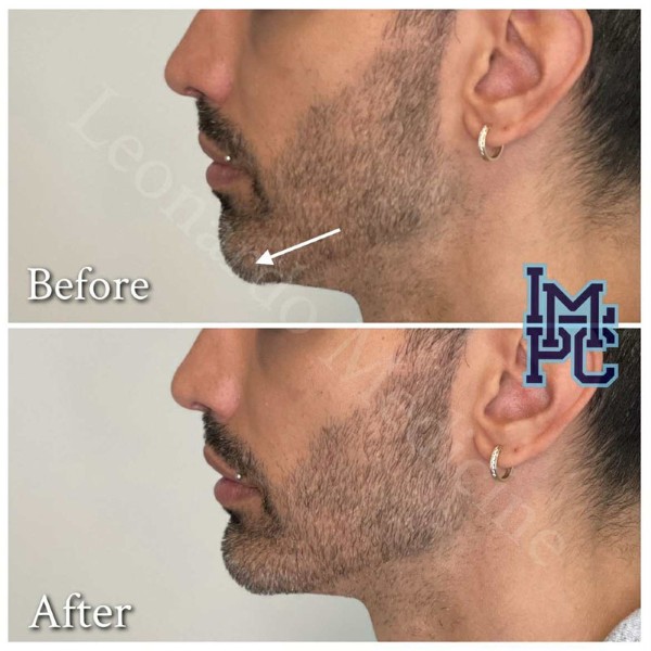 Lower Face Filler treatment 46