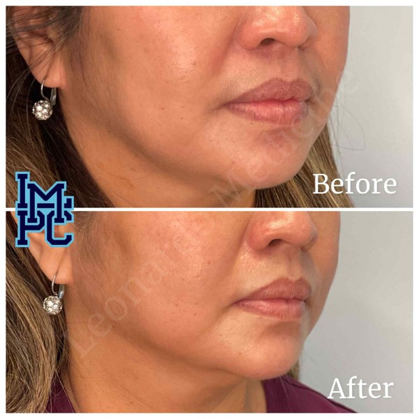 Lower Face Filler treatment 50