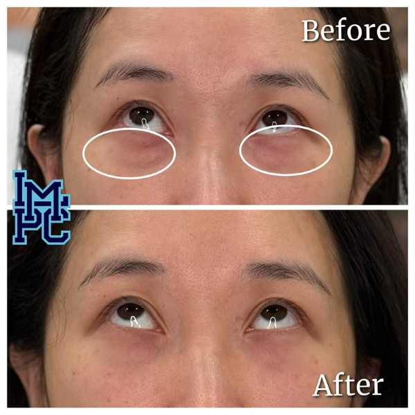 Middle Face Filler treatment 15