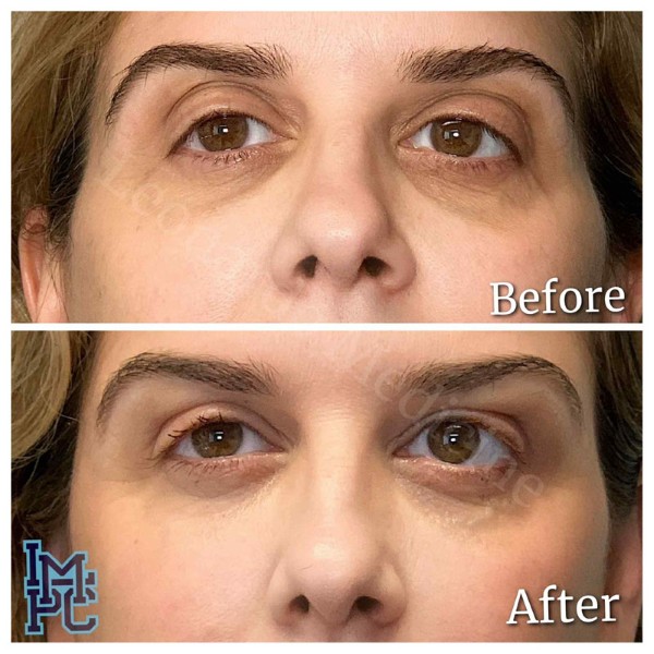 Middle Face Filler treatment 17