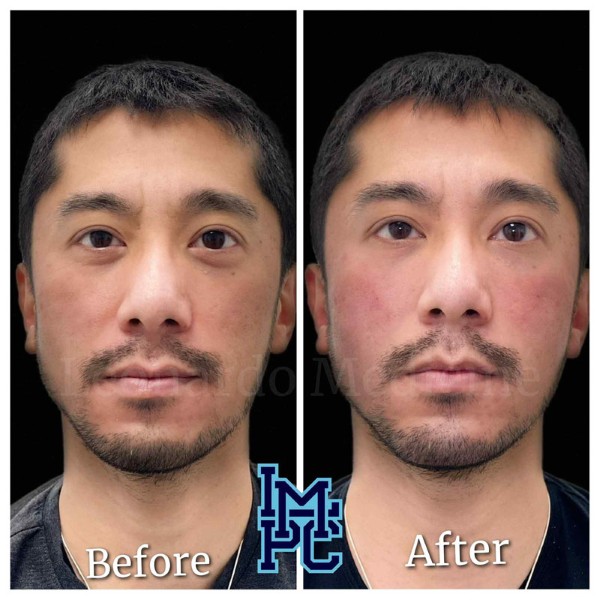Middle Face Filler treatment 23