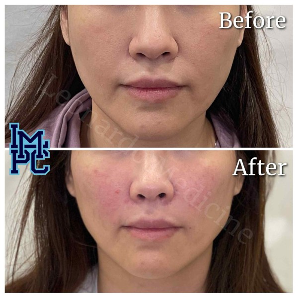 Middle Face Filler treatment 38
