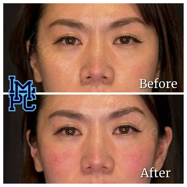 Middle Face Filler treatment 8