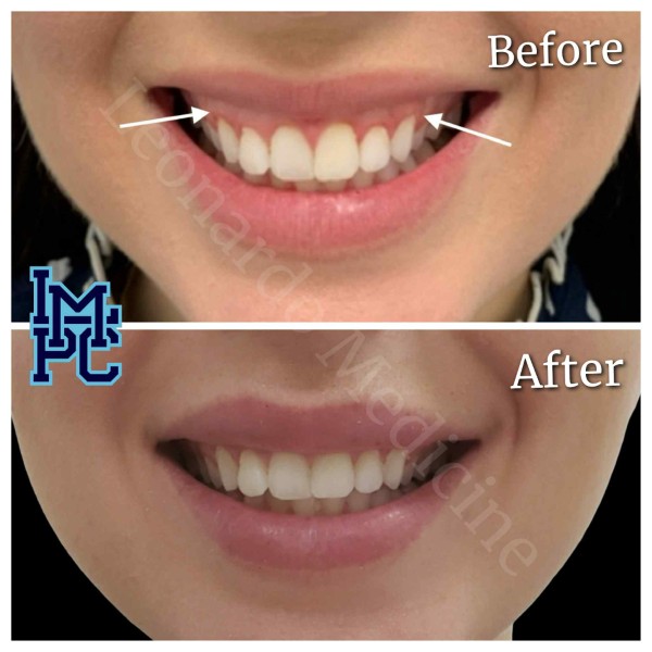 Lower Face/Neck Tox treatment 1
