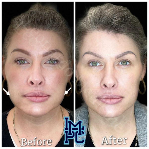 Lower Face/Neck Tox treatment 10