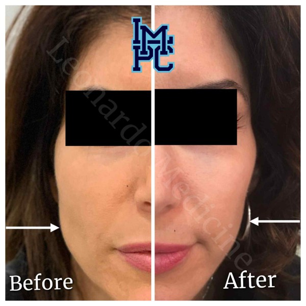 Lower Face/Neck Tox treatment 11