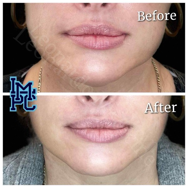 Lower Face/Neck Tox treatment 12