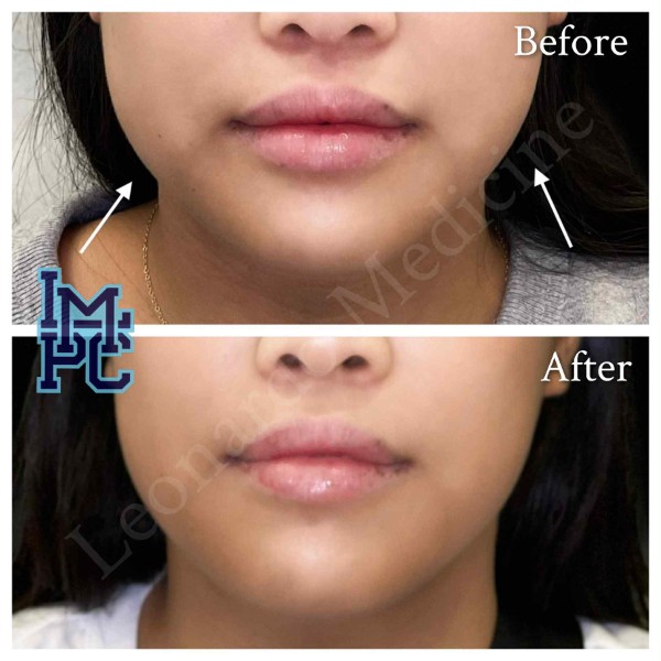 Lower Face/Neck Tox treatment 13