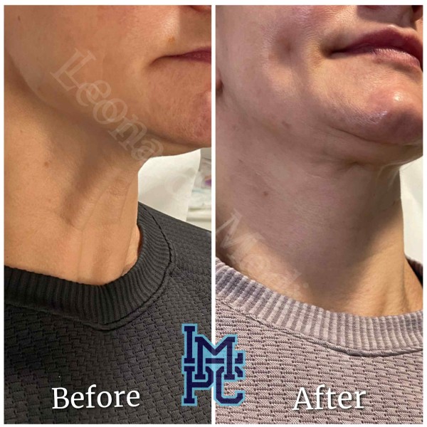 Lower Face/Neck Tox treatment 2