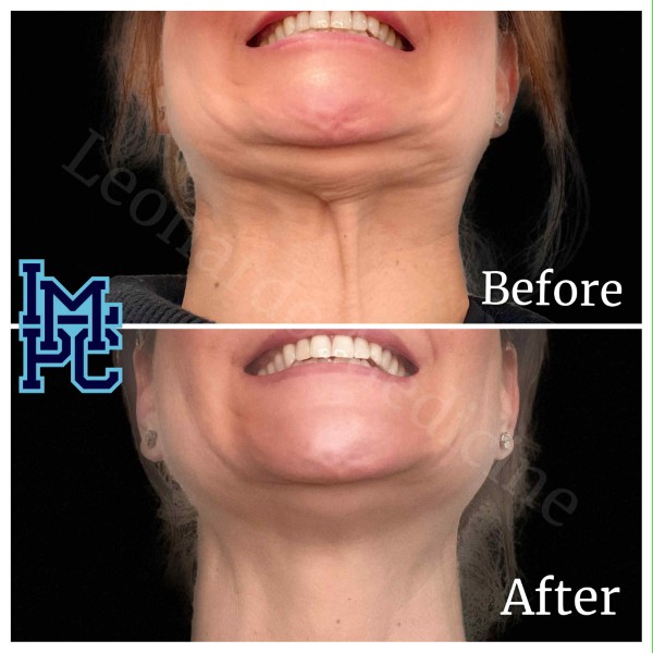 Lower Face/Neck Tox treatment 3