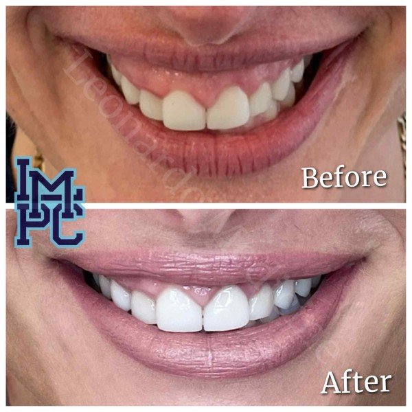 Lower Face/Neck Tox treatment 4