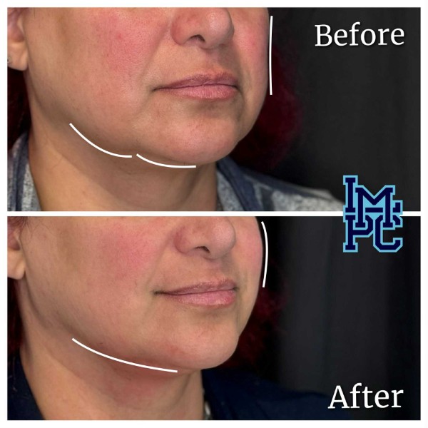 Lower Face/Neck Tox treatment 5