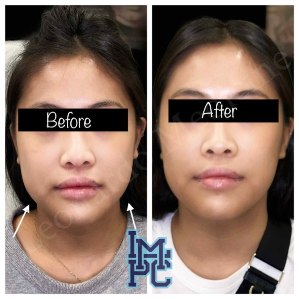 Lower Face/Neck Tox treatment 6