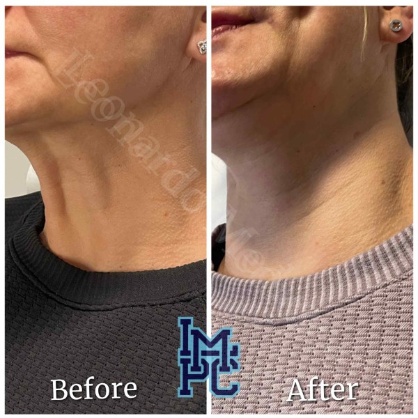 Lower Face/Neck Tox treatment 7