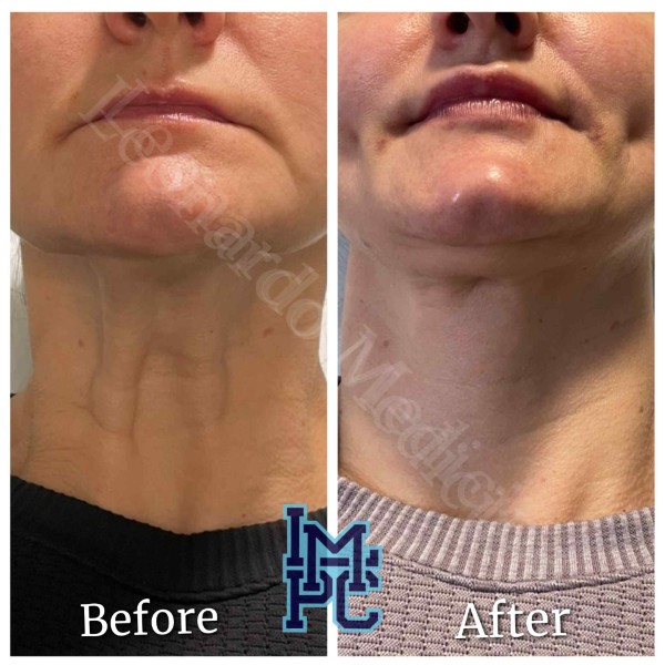 Lower Face/Neck Tox treatment 8