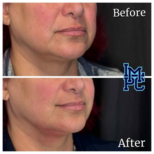 Lower Face/Neck Tox treatment 9